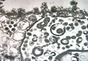 cytomegalovirus - pneumonia cytomegalovirus - pneumonia